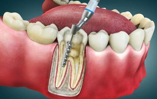 Root Canal Treatment